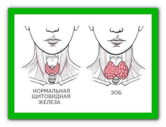 Где зоб. Народные методы щитовидная железа.