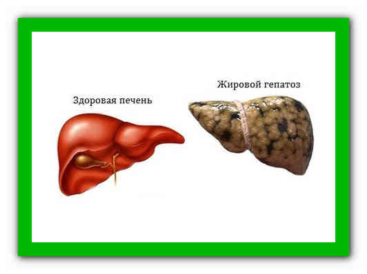 Гепатоза гепатомегалии