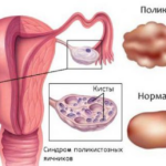 polikistoz-yaichnikov-simptomy-i-lechenie-narodnymi-sredstvami