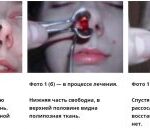 polipy-v-nosu-lechenie-v-domashnix-usloviyax