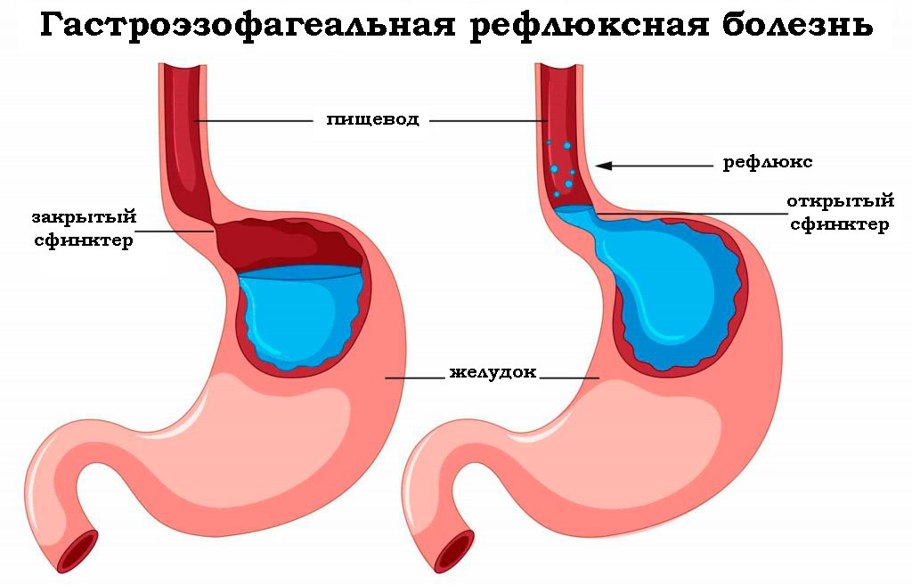 reflyuks-ezofagit-lechenie-narodnymi-sredstvami-samoe-luchshee