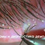 resnichnyj-kleshh-lechenie-narodnymi-sredstvami