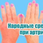 revmatoidnyj-poliartrit-lechenie-narodnymi-sredstvami