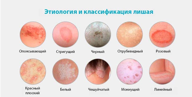 rozovyj-lishaj-lechenie-v-domashnix-usloviyax-bystro