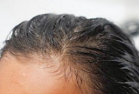 seborejnyj-dermatit-lechenie-v-domashnix-usloviyax