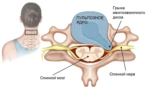 shejnaya-gryzha-lechenie-v-domashnix-usloviyax