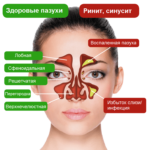 simptomy-gajmorita-u-vzroslyx-lechenie-v-domashnix