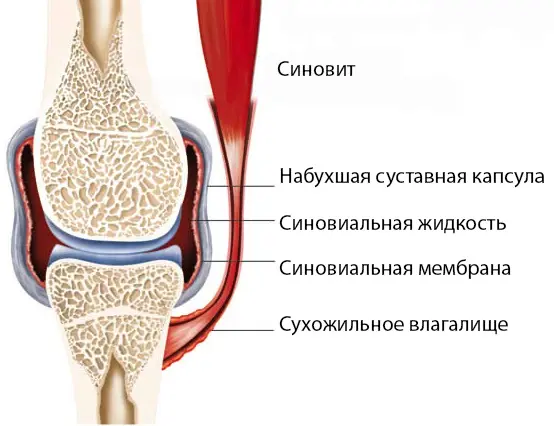 sinovit-lechit-narodnymi-sredstvami