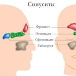 sinusit-narodnye-metody-lecheniya