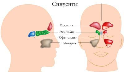 sinusit-simptomy-i-lechenie-v-domashnix-usloviyax