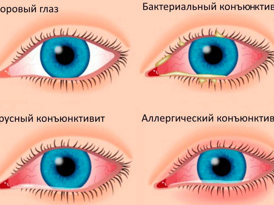 slezotochivost-glaz-prichiny-i-lechenie-narodnymi-sredstvami