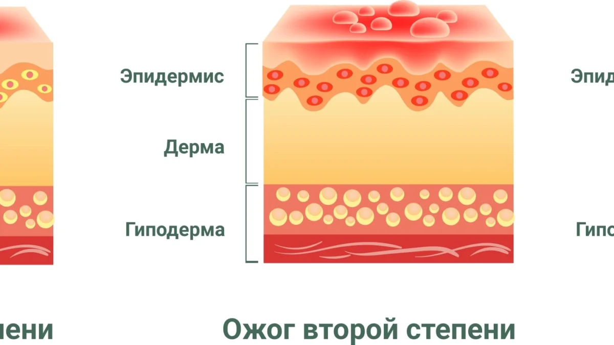 solnechnyj-ozhog-lechenie-v-domashnix-usloviyax-bystro