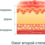 solnechnyj-ozhog-lechenie-v-domashnix-usloviyax-bystro