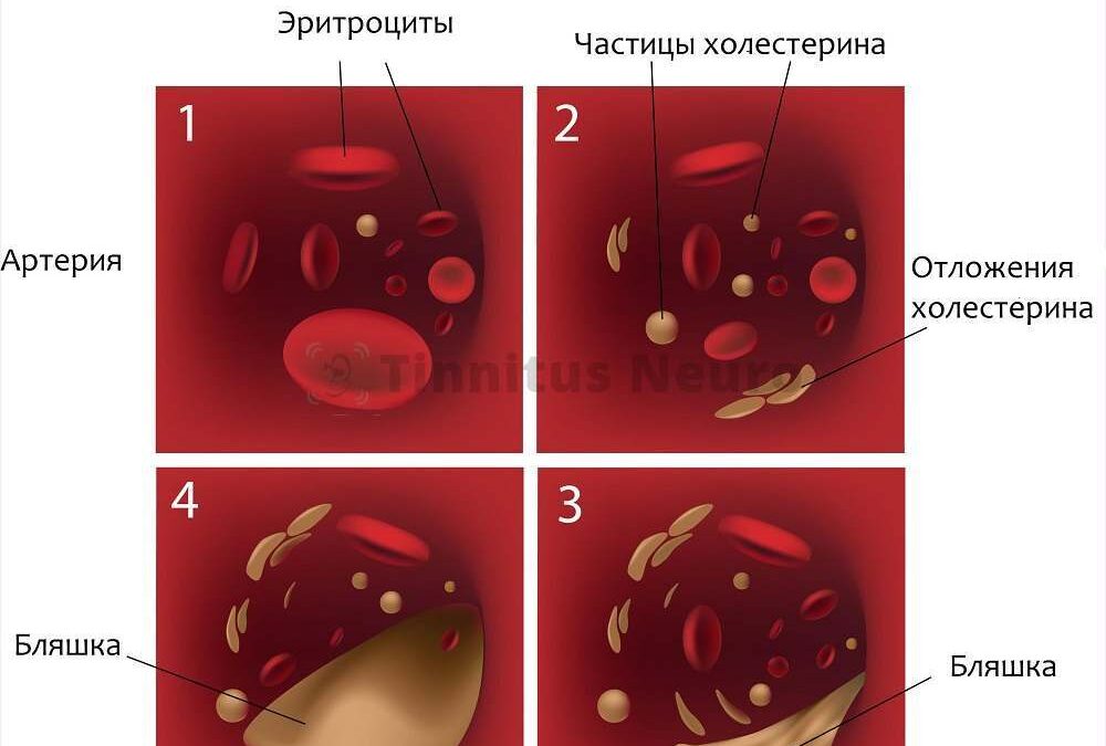sosudy-golovnogo-mozga-simptomy-lechenie-narodnymi-sredstvami