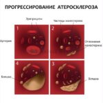 sosudy-golovnogo-mozga-simptomy-lechenie-narodnymi-sredstvami