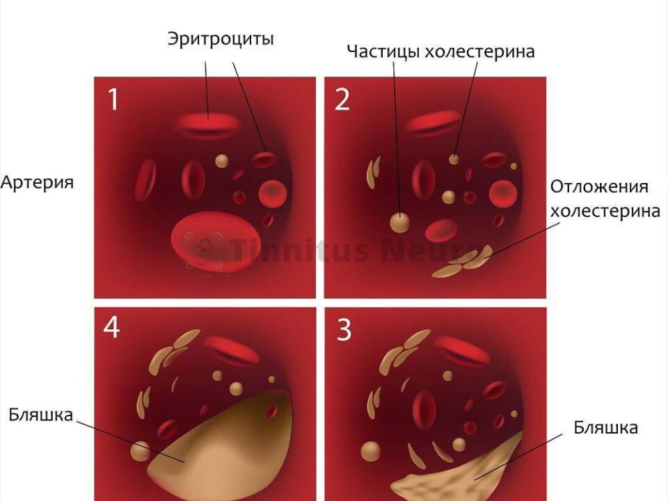 sosudy-golovnogo-mozga-simptomy-lechenie-narodnymi-sredstvami