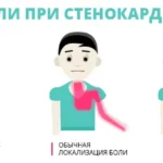 stenokardiya-simptomy-i-lechenie-v-domashnix-usloviyax