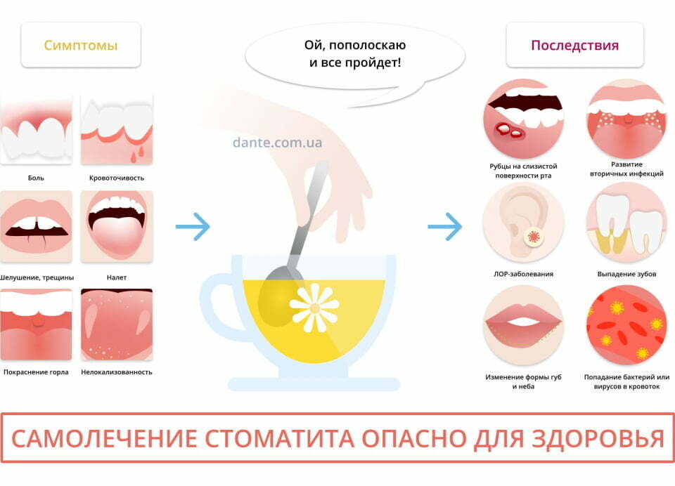 stomatit-lechenie-v-domashnix-usloviyax-u-vzroslyx
