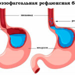 suzhenie-pishhevoda-lechenie-narodnymi-sredstvami
