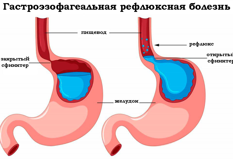 suzhenie-pishhevoda-lechenie-narodnymi-sredstvami