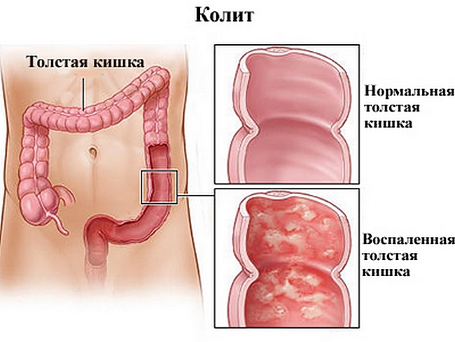 xronicheskij-kolit-kishechnika-lechenie-narodnymi-sredstvami-otzyvy