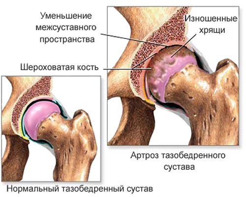 kak-lechit-koksartroz-tazobedrennogo-sustava-narodnymi-sredstvami