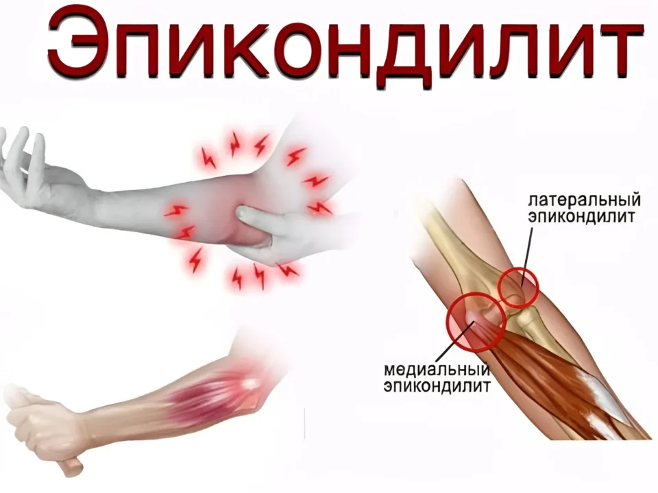 lateralnyj-epikondilit-loktevogo-sustava-lechenie-narodnymi-sredstvami