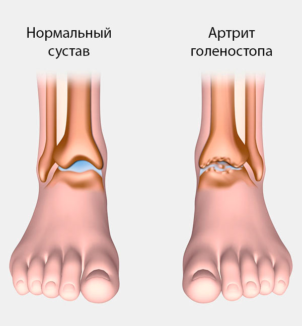 lechenie-artrita-stopy-nog-v-domashnix-usloviyax