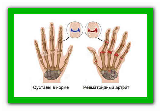 Лечение артрита пальцев народными средствами. Артрит пальцев рук народными средствами. Народные средства от артрита пальцев рук.